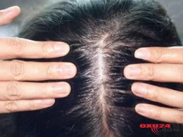 Dazlaşmadan 1 ayda xilas olun - BU YAĞIN 5 DAMCISI KİFAYƏTDİR