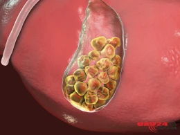Yağdan imtina edən insanlarda öd daşı daha da çoxalıb, böyüyür – Rusiyanın tanınmış hepatoloqu