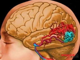 İnsultu qabaqcadan müəyyən edən TEST