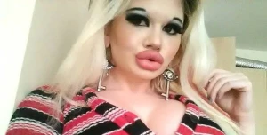 Tələbə dünyanın ən iri dodaqlı qızı olmaq istəyir - FOTO