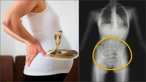 Həkimlər şokda: Hamilə qadının bətnindən uşaq əvəzinə ilan çıxdı