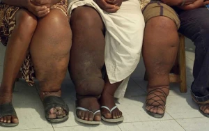 İnsanda olan dəhşətli fil xəstəliyi nədən yaranır?