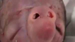 "Uşaqlar niyə qüsurlu doğulur?"-Həkim-ginekoloqdan VACİB AÇIQLAMA