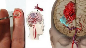İnsult zamanı xəstənin barmaqlarını deşin - İLK YARDIM