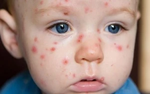 Azərbaycanda koksaki virusunun olduğu təsdiqləndi