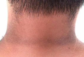 Boynun qaralması hansı xəstəliyin simptomlarıdır?