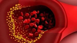 Damar tıxanmasına və insulta səbəb olan QİDALAR