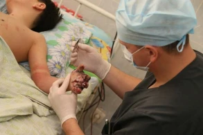 Pirotexnik vasitə uşağın barmaqlarını qopartdı