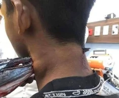 Sudan tullanan balıq oğlanın boynunu deşdi - FOTO (18+)