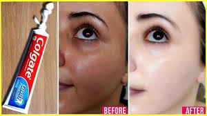 Ev şəraitində üzdəki ləkələri belə aparın  —  VİDEO