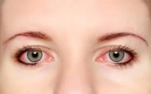 Gözdə qan damarları niyə partlayır?- SƏBƏBLƏR