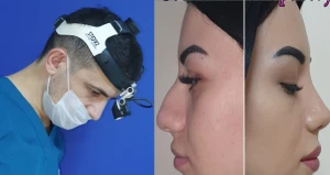 При проведении операции на нос обратите внимание на это! Пластический хирург Санан Мехтиев заявил +фото