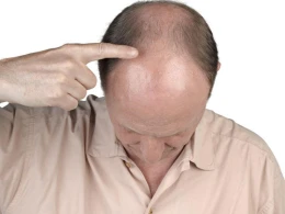 47 yaşlı kişi saç əkimi zamanı öldü&nbsp;