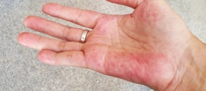 Əldəki və üzdəki səpkilər bu xəstəliyin əlamətləri imiş - HƏKİMDƏN AÇIQLAMA&nbsp;