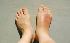 Ayaqda yaranan bu şişi GÖRMƏZDƏN GƏLMƏYİN – Ölümcül xəstəliklərin ilk əlaməti ola bilər…  