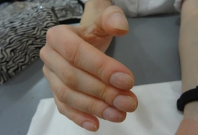 Barmaqlarınızda bu dəyişiklik varsa... Çox təhlükəli simptom