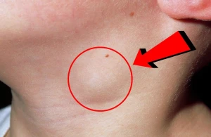 Həkimdən limfa düyünləri ilə bağlı VACİB MƏLUMAT&nbsp; —&nbsp; &nbsp;Hansı hallarda TƏHLÜKƏLİDİR?