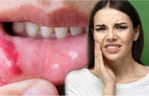 Ağız yaraları ilə bağlı qorxunc XƏBƏRDARLIQ