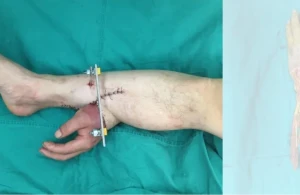 Qopan əli ayağa tikdilər&nbsp;