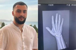 Qolunda "mil" olan gəncin hərbi xidmətə çağırılması ilə bağlı xəbərə RƏSMİ AÇIQLAMA + HÜQUQŞÜNAS MÖVQEYİ&nbsp;&nbsp;