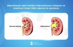 Bu xəstəliyin müalicəsini icbari tibbi sığorta qarşılayır