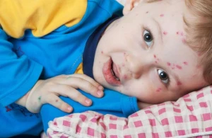 Suçiçəyi ilə bağlı vacib tövsiyə! Bunu etməyin - Həkim AÇIQLADI