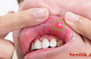 Xərçəngin gözə çarpmayan əlamətləri – Diqqətli olun