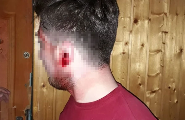 Bakıda ŞOK! Polis sürücünün qulağını qopardı - FOTO