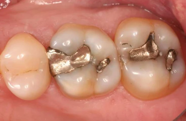 Diş çürüyünü müalicə edəcək 40 qəpiklik üsul - YENİ KƏŞF