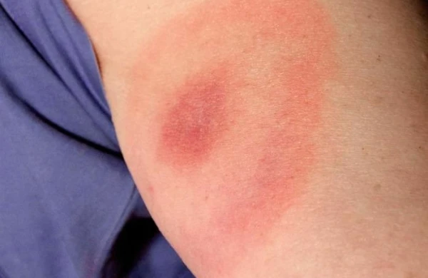 Qusarda zəhərli gənə uşağı ölümcül dişlədi – Valideynlər diqqətli olsun