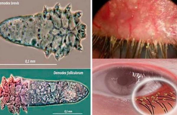 Kirpik gənəsi xəstəliyi nədir? - Xəbərdar olun ki, qorunasınız!