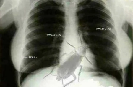 Azərbaycanlı həkim xəstəyə "sinəndə böcək var" deyib xaricə göndərdi, BİABIR OLDU - FOTOFAKT