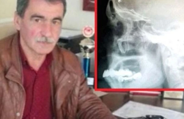 Başı ağrıyan kişini rentgenə saldılar - Həqiqəti görən həkim mat qaldı