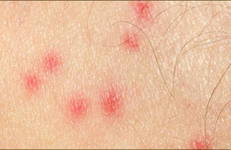 Bədəninizdə qırmızı NÖQTƏLƏR VARSA, bu yazını mütləq OXUYUN