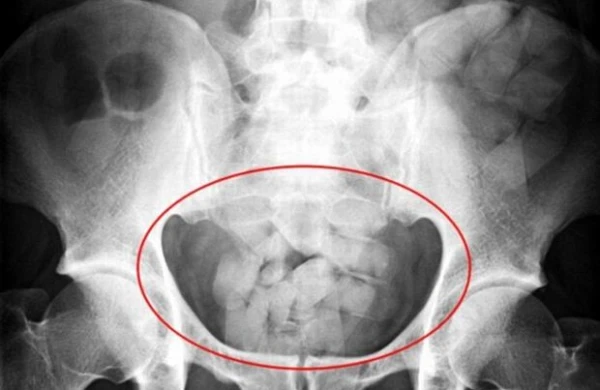 Arxasından narkotik çıxdı - Gömrükdə biabırçılıq