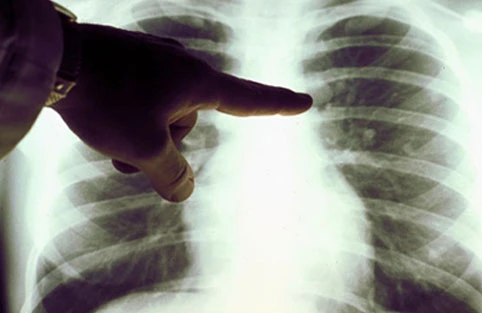 Ağciyər xərçənginin 7 əlaməti - DİQQƏT!