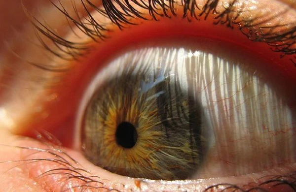 Gözünüzün ağında ləkə varsa TƏCİLİ HƏKİMƏ GEDİN - Kor ola bilərsiniz