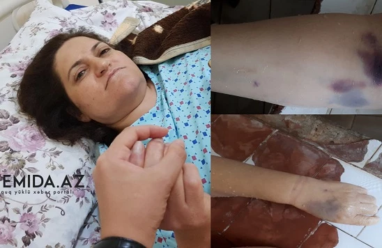 Bakıda şok! Uşaqlığı çıxarılan qadın zülümlə öldü - 18+ FOTOLAR