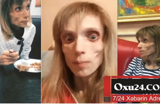 26 yaşı var, amma 17 kiloqramdır – Fotolar