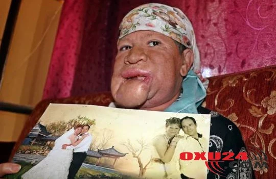 Çənəsindən çıxan sızanağa əhəmiyyət verməyən qadının həyatı alt-üst oldu - FOTOLAR