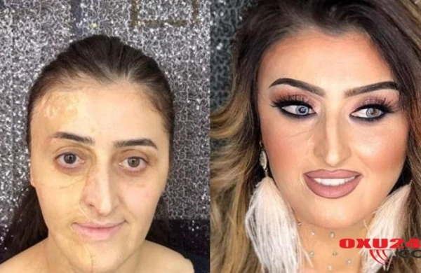 Azərbaycanda üzü tamamilə yanan qızın İNANILMAZ DƏYİŞİMİ