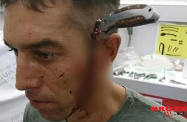 Başına 15 santimetrlik bıçaq saplanan kişi hamını DƏHŞƏTƏ GƏTİRDİ: həkimə piyada getdi və... - FOTO Cinayət dünyası