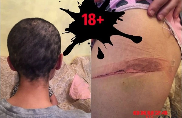 Saçı qırxılan qadına verilən işgəncə izlərinin ŞOK görüntüləri yayıldı (Fotolar, +18)