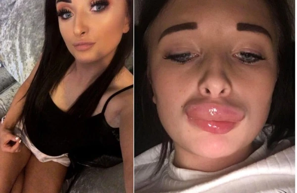 Dodağına silikon vurdu, belə oldu - VİDEO