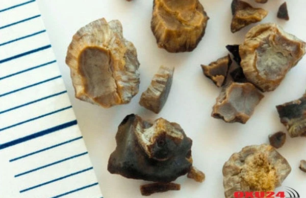 Böyrək və öd kisəsi daşlarından təbii yolla azad olun - Qəpik-quruşluq reseptlər