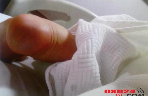 Doğum evində hamilə qadının ayağını yandırdılar - FOTO