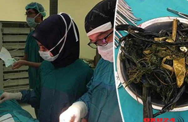 Uşağın mədəsindən çıxanlar həkimləri ŞOKA SALDI