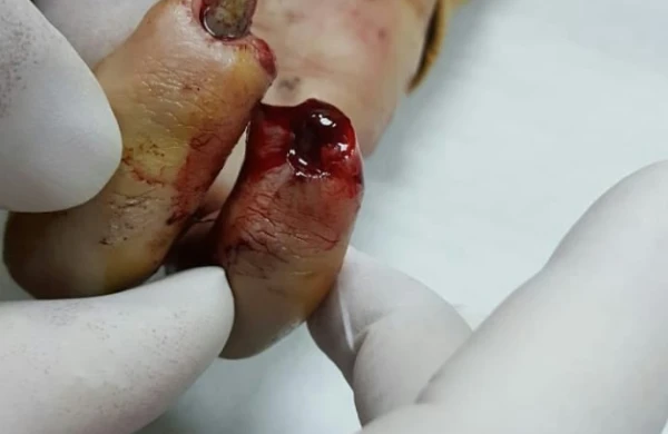 Bakıda pirotexniki vasitə turistin əlində partladı, iki barmağı kəsildi