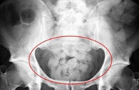 Azərbaycanda ŞOK olay: Gömrük işçiləri qadının cinsiyyət orqanından briliant çıxardı