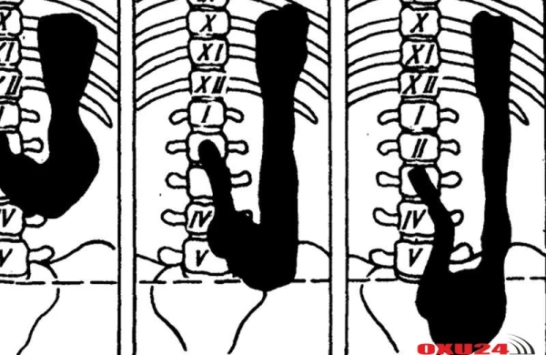 Mədə sallanması nədir, əlamətləri – Mədəni yerinə necə çəkməli?